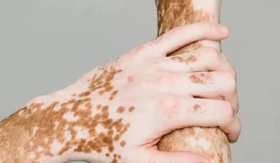 25 Haziran dünya vitiligo günü dolayısıyla farkındalık çağrısı