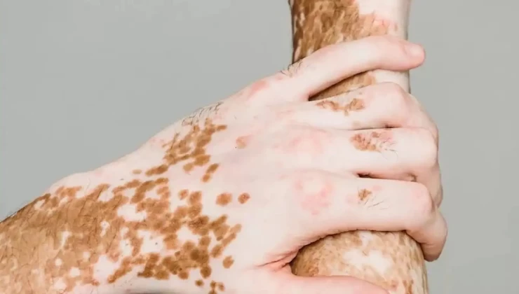 25 Haziran dünya vitiligo günü dolayısıyla farkındalık çağrısı