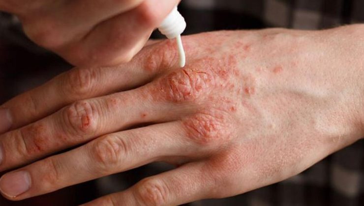 Soğuklarda cilt kuruluğuna karşı 10 tavsiye