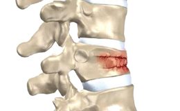 Omurga kırıkları kış aylarında artıyor