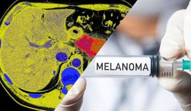 Kişiye özel kanser aşısı, melanomun tekrarlama riskini yüzde 42 azalttı